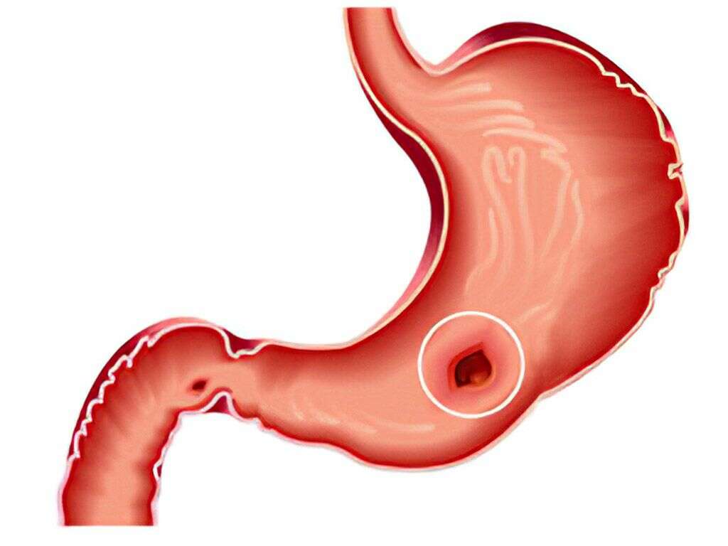 Peptic ulcer: how to identify by tests